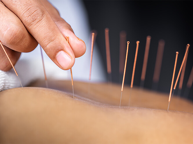 Acupuncture_732x549-thumbnail